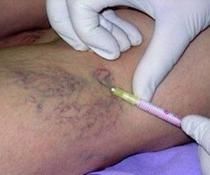 injection-from-varicose veins