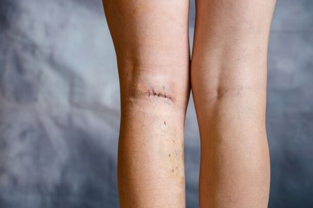 seam on leg after varicose veins surgery