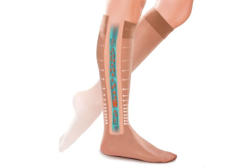 The effect of compression stockings on varicose veins on the legs