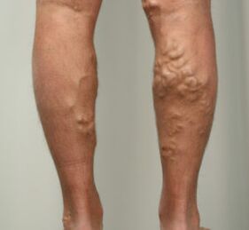 Nodules in the legs with varicose veins