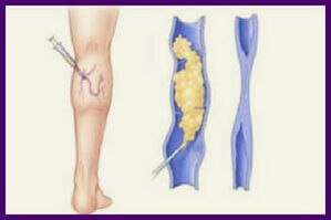 Sclerotherapy is a popular method of removing varicose veins on the legs