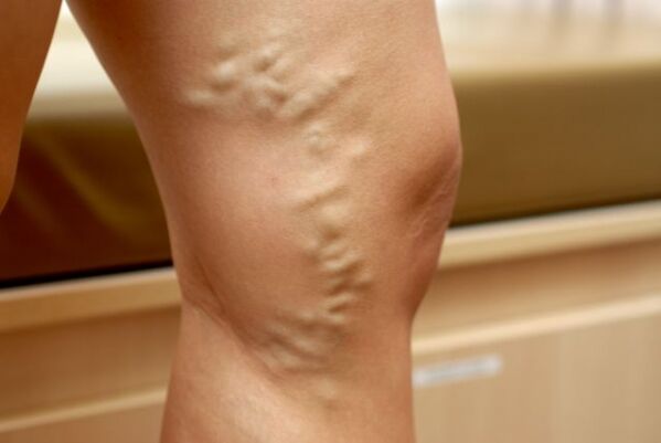 Varicose veins in the legs with small pelvic varicose veins