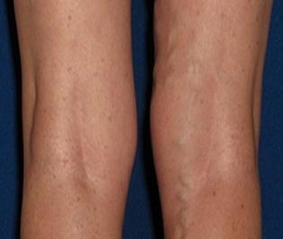 the treatment of varicose veins in the legs