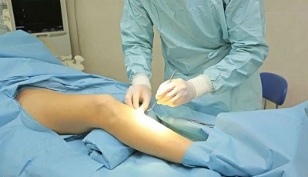 How surgery is performed for varicose veins