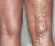 the treatment of veins