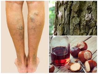 the treatment of varicose veins in the legs folk remedies