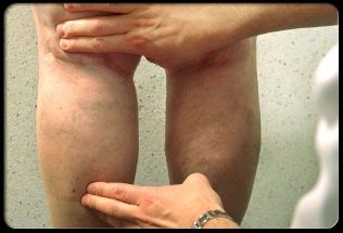 The doctor examines the legs with varicose veins