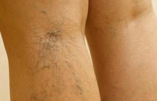 the treatment of varicose veins in the legs