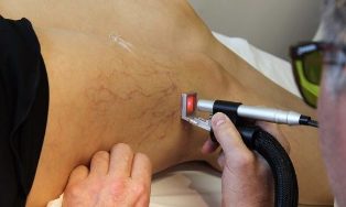 the treatment of varicose veins with laser