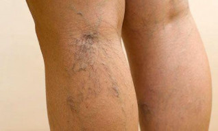 varicose veins of the legs.