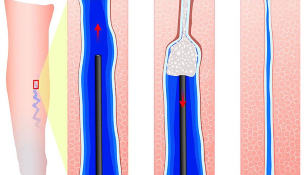 Introduction sclerosant when sclerotherapy