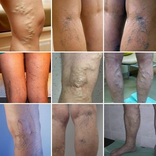 Picture of varicose veins of the lower limbs